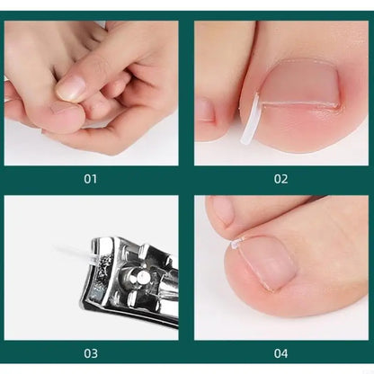 Ingrown Toenail Corrector Strips
