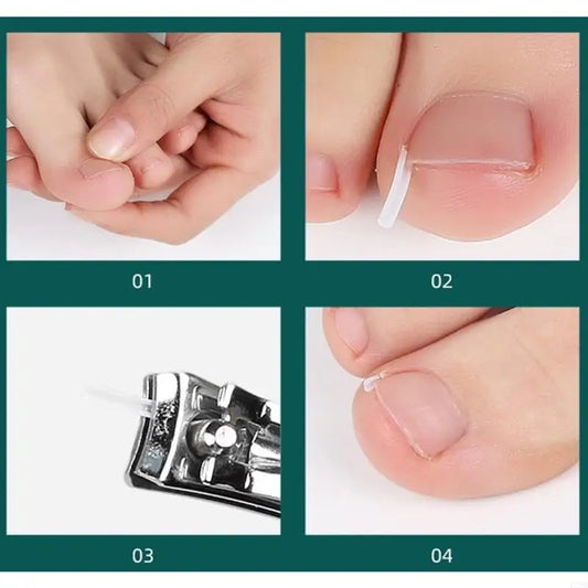 Ingrown Toenail Corrector Strips