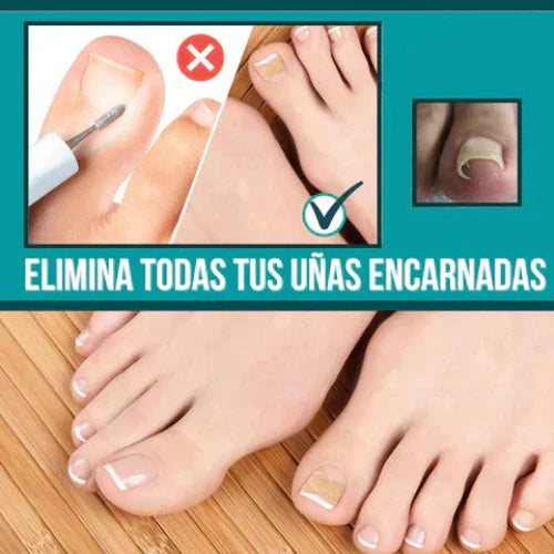 Ingrown Toenails and Fungal Infections