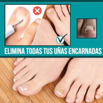 Ingrown Toenails and Fungal Infections