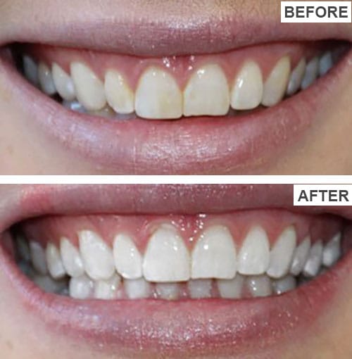 HISMILE V34 TEETH WHITENING SERUM