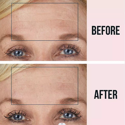 Anti-Wrinkle Microneedling Patches for Forehead ✨👩‍🦱