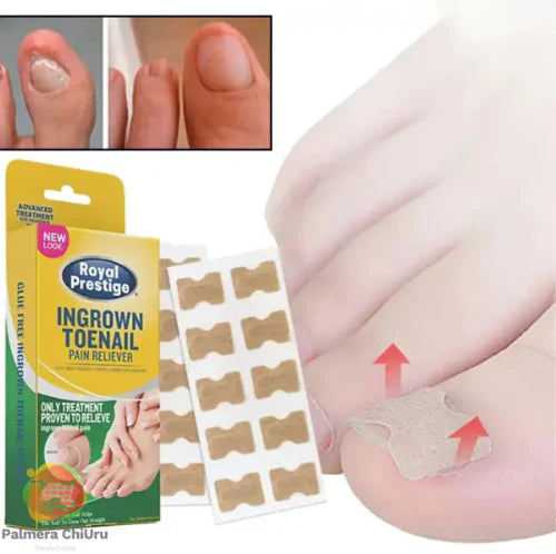 Ingrown Toenails and Fungal Infections